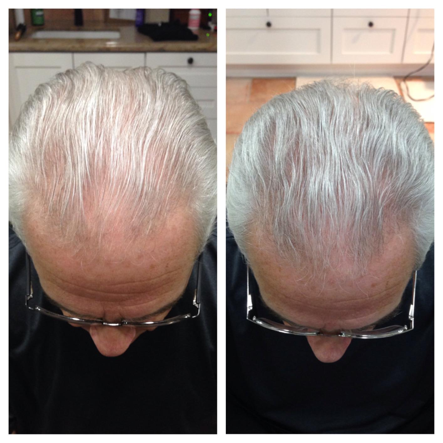Theradome PRO Laser Hair Growth Helmet LH80 - 100% Laser, No Ineffective LEDs - FDA-Cleared Red Light Therapy for Hair Regrowth 2x Week - Made in the USA customer photo 2