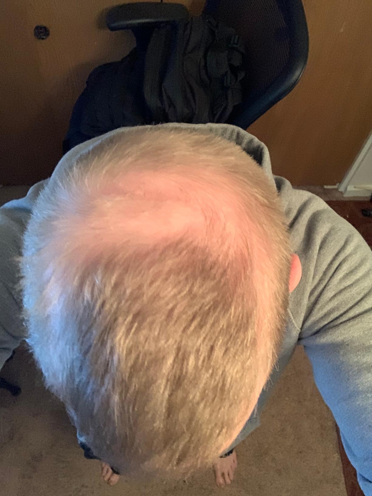 iRestore Essential - Laser Red Light Therapy for Hair Growth - FDA Cleared Hair Loss, Hair Thinning & Alopecia Treatment for Men & Women - Laser Cap for Hair Regrowth Stimulate Denser Fuller Hair customer photo 2