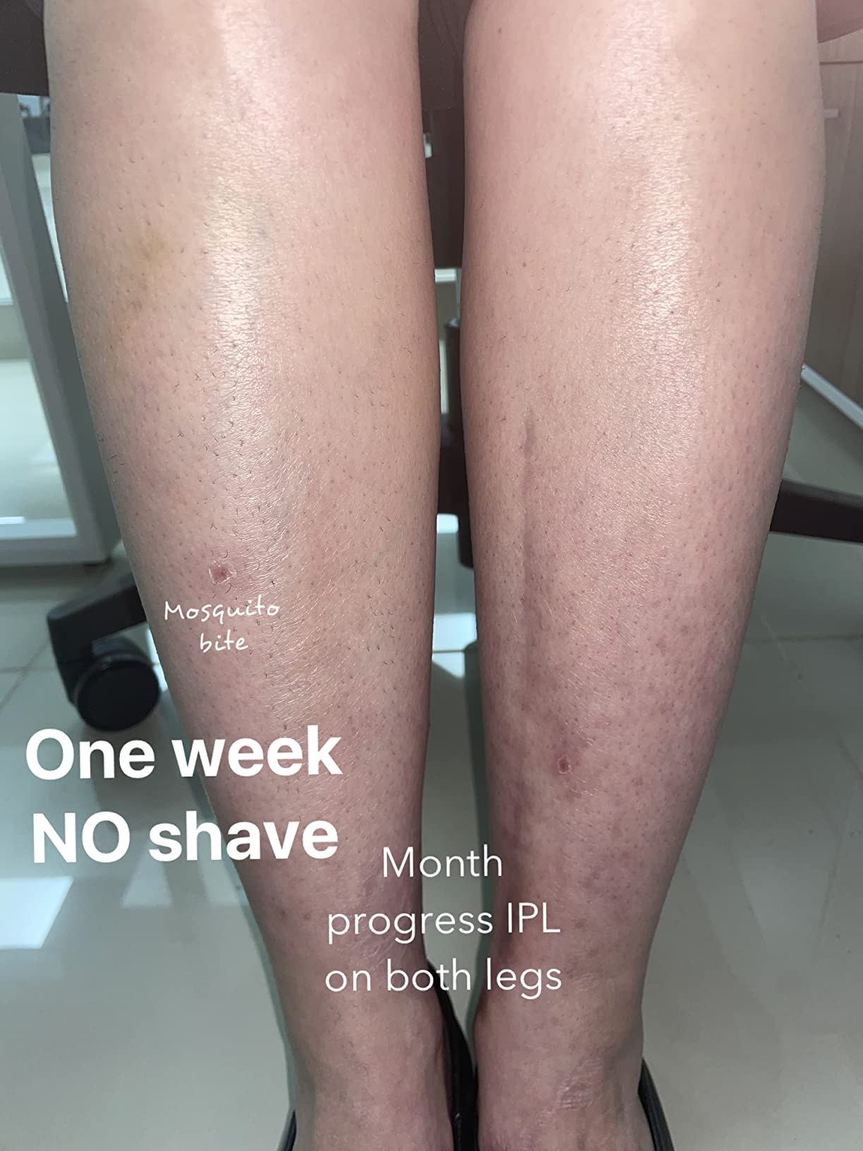 Braun IPL, Silk·Expert Pro 5, IPL Hair Removal for Women and Men, Permanent Laser Hair Reduction At-Home, 2 Heads, Pouch, Venus Razor, IPL5157 customer photo 1