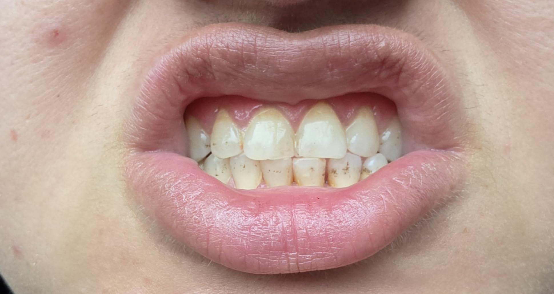 Auraglow Teeth Whitening Kit, LED Accelerator Light, 35% Carbamide Peroxide Teeth Whitening Gel, 20+ Whitening Treatments, Whitens up to 10 Shades in 7 Days customer photo 1