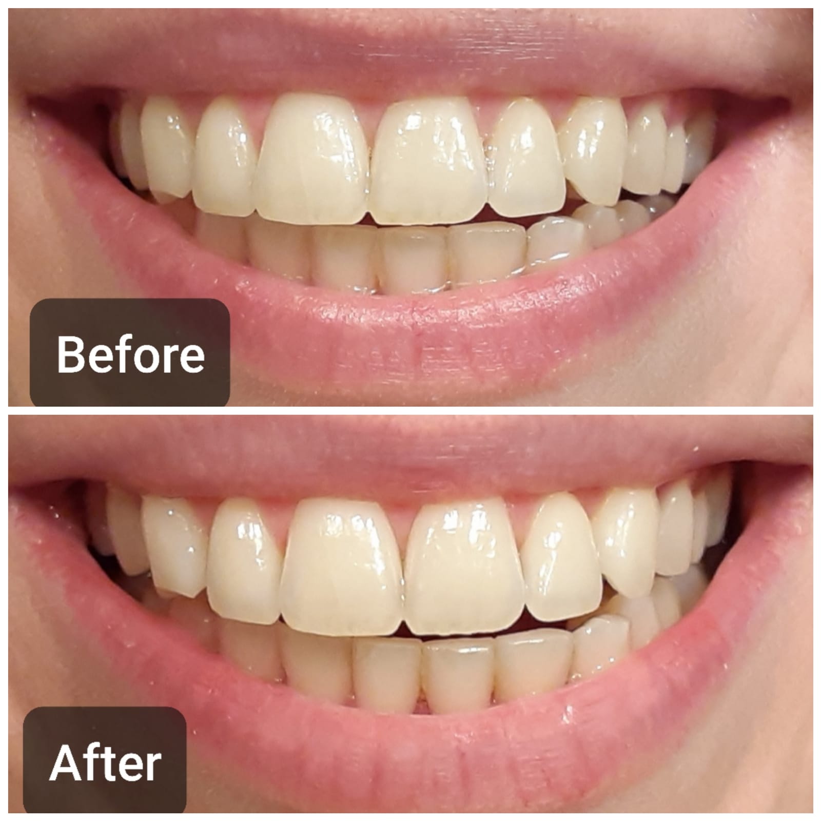 Auraglow Teeth Whitening Kit, LED Accelerator Light, 35% Carbamide Peroxide Teeth Whitening Gel, 20+ Whitening Treatments, Whitens up to 10 Shades in 7 Days customer photo 2