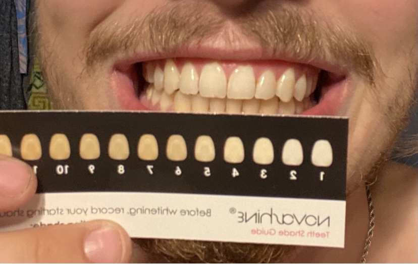 Novashine Professional Teeth Whitening Kit: Advanced Blue LED Light, Concentrated Peroxide Gel, Smartphone Adapter, Travel Bag customer photo 2