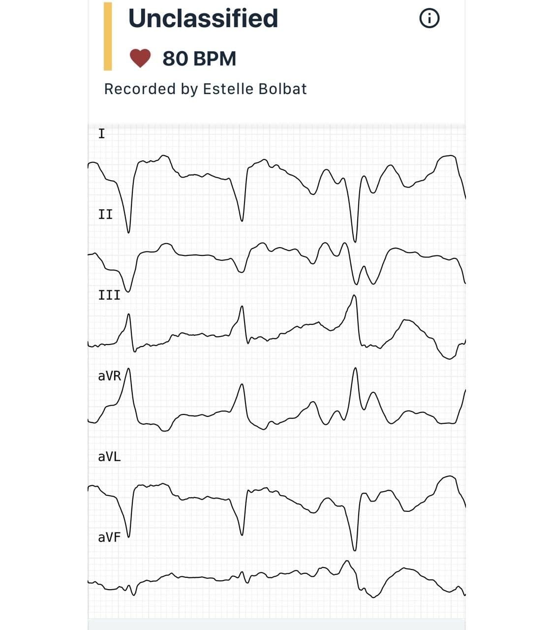 KardiaMobile 6L EKG, No Membership Required, Unlimited Recordings, HSA/FSA customer photo 1