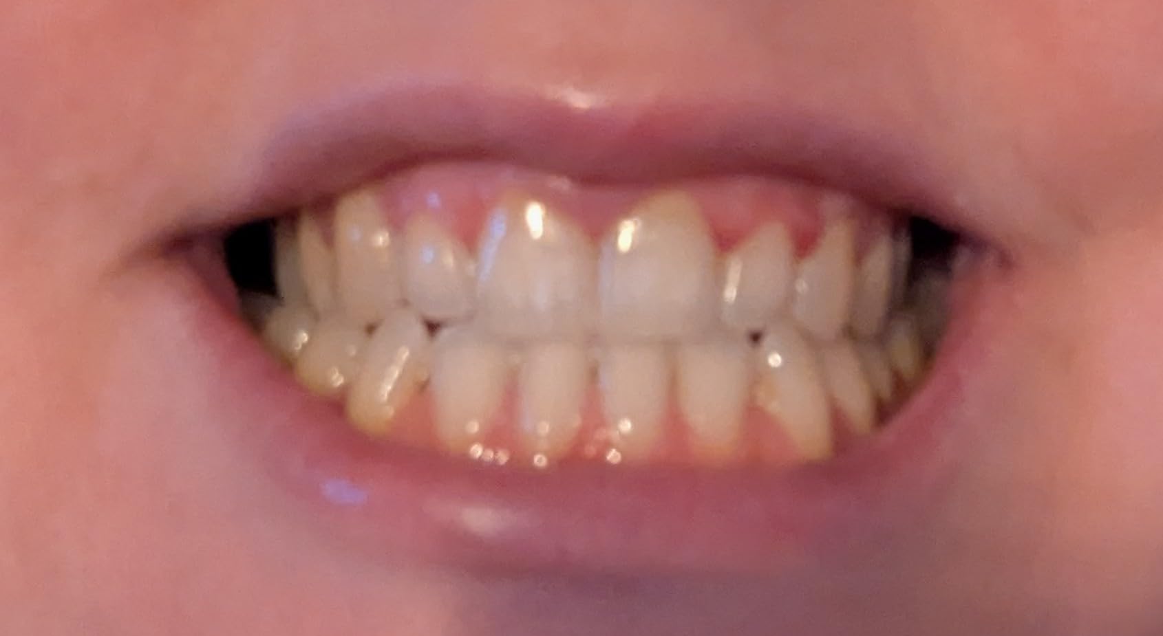 Crest 3DWhitestrips Sensitive White At-Home Teeth Whitening Kit, 18 Treatments, Gently Removes 15 Years of Stains customer photo 2