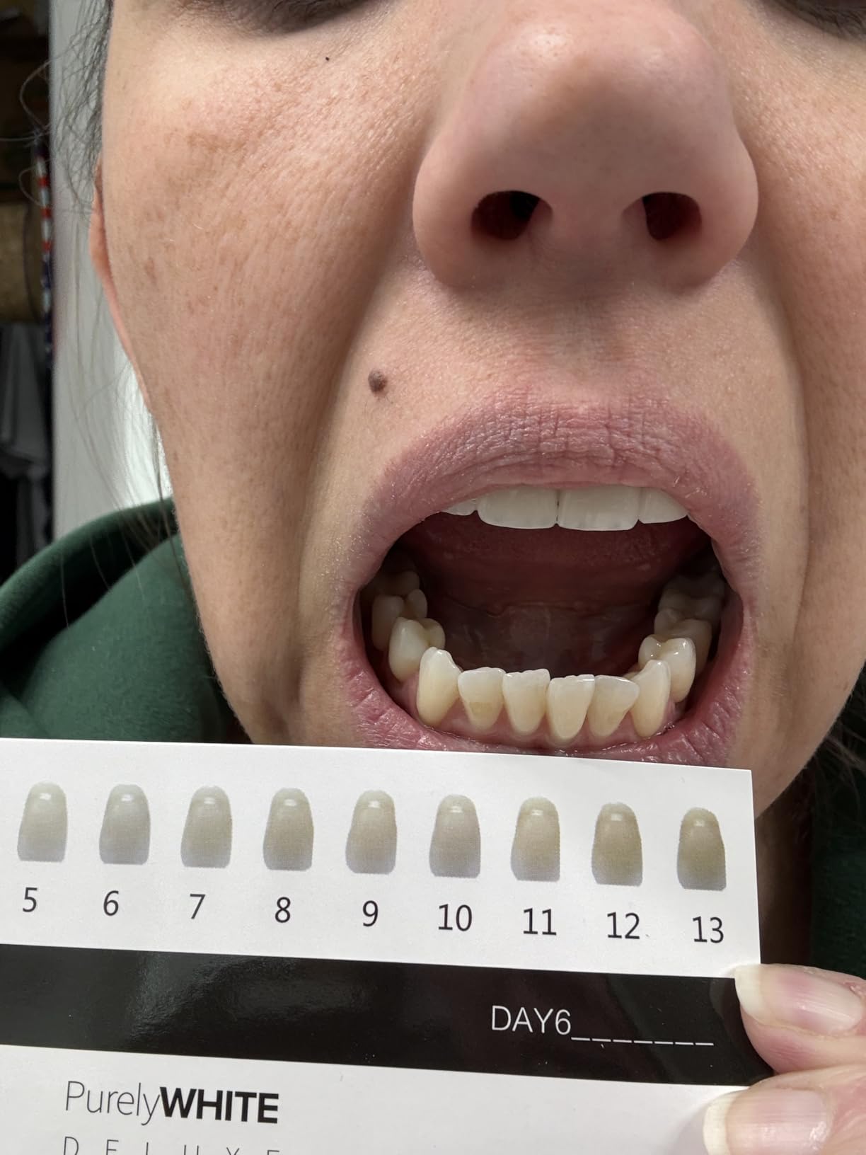 PurelyWHITE DELUXE Teeth Whitening Kit, Complete LED Teeth Whitening, 15+ Treatments, (3) 3ml Whitening Gel Syringes, Whiter Smile in 7 Minutes customer photo 2