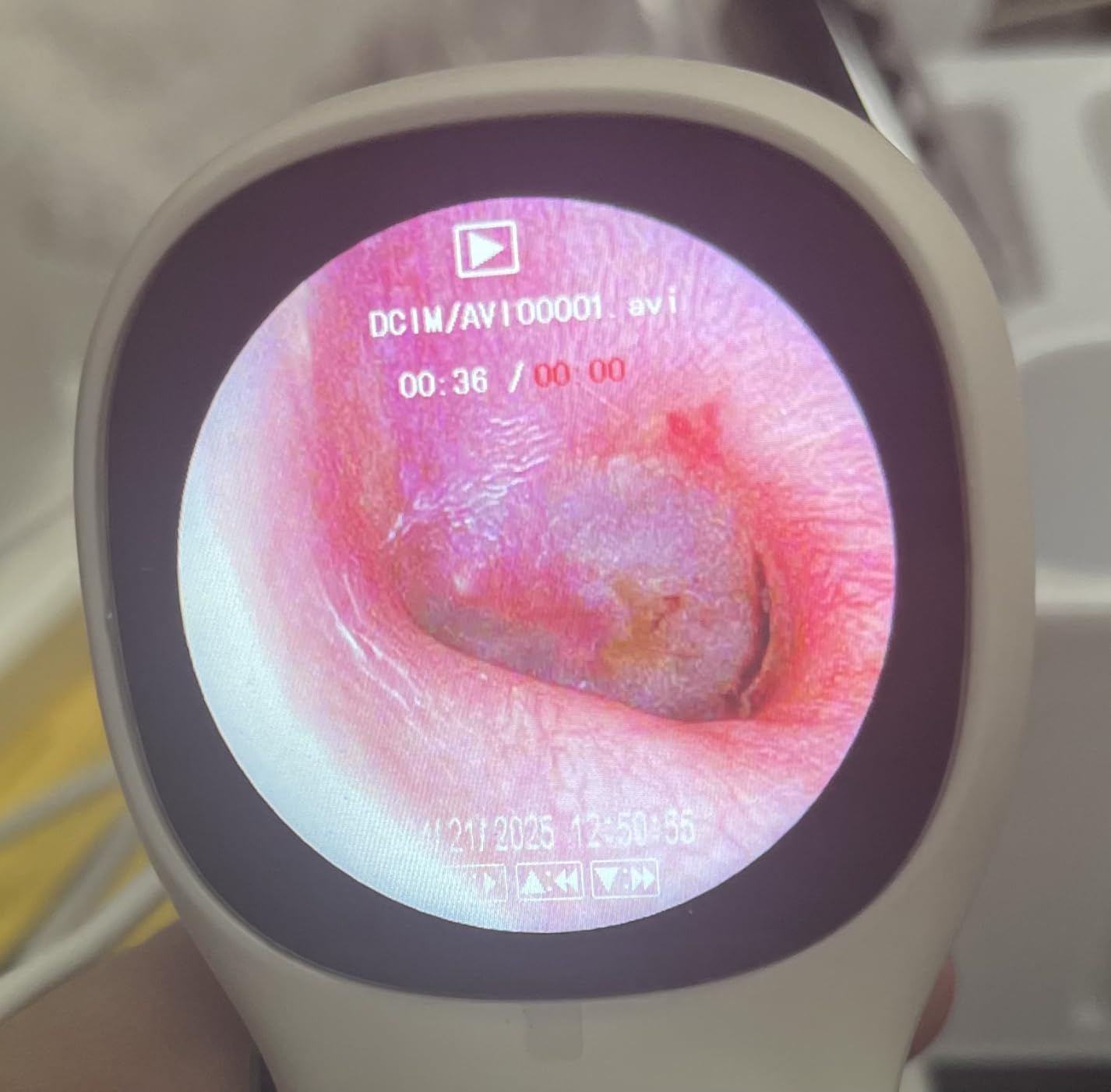 Otoscope with Light, No App Needed, HD Screen, Ear Scope Camera for Family customer photo 2