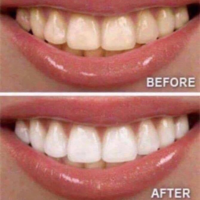 Teeth Whitening Kit with LED Light Tray for Sensitive Teeth, 5 Tooth Whitening Pen Gel Pain Free and Enamel Safe, Teeth Whitener at Home Up to 1-9 Shades Whiter in 1-2 Weeks customer photo 1