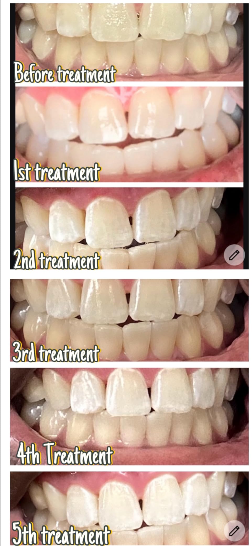 Luelli Teeth Whitening Kit with 35% Carbamide Peroxide - Teeth Whitener for Sensitive Teeth | Enamel Safe - 32 LED Lights - Wireless with Tray and Whitening Gel Pen for Home | Travel (Mint) customer photo 1